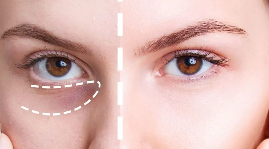 Tratamiento ojeras con radiofrecuencia