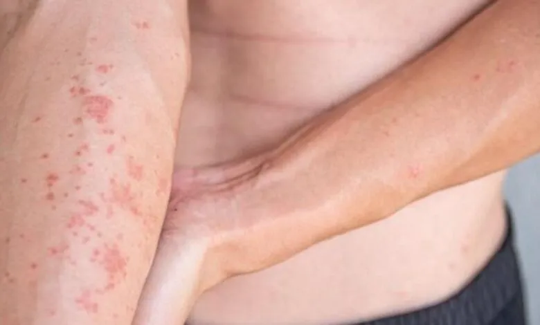 persona con picor en la piel estrés