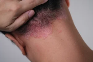 Placas de psoriasis en la nuca con enrojecimiento